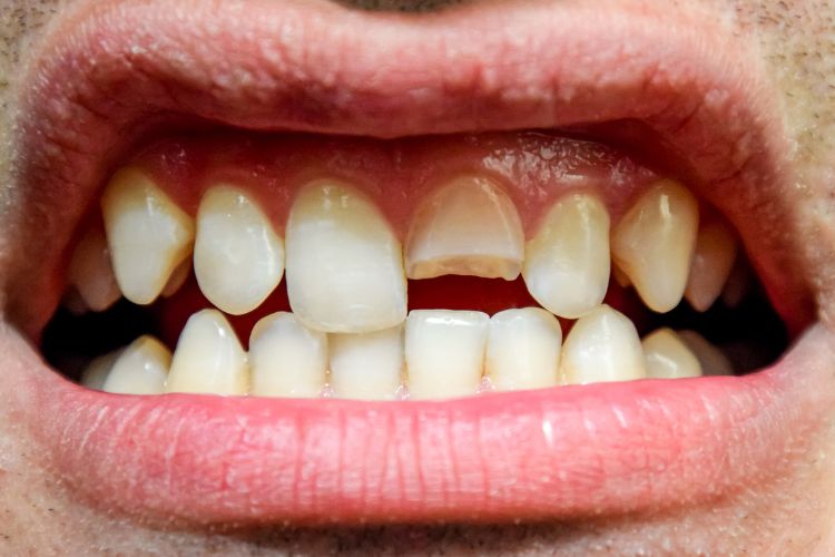 What to Do If You Have A Chipped Tooth