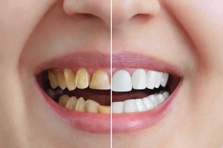 The Benefits of Dental Crowns for Restoring Damaged Teeth
