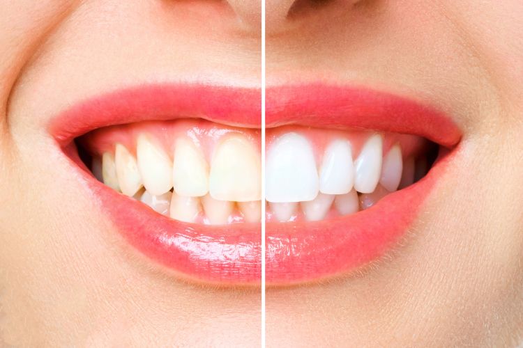 The Benefits of Professional Teeth Whitening vs. At-Home Treatments