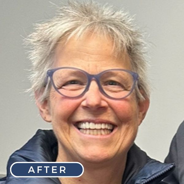 all on four dental implants easton pa