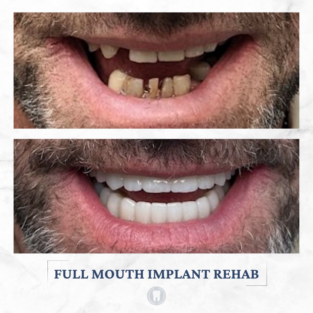 dental implants