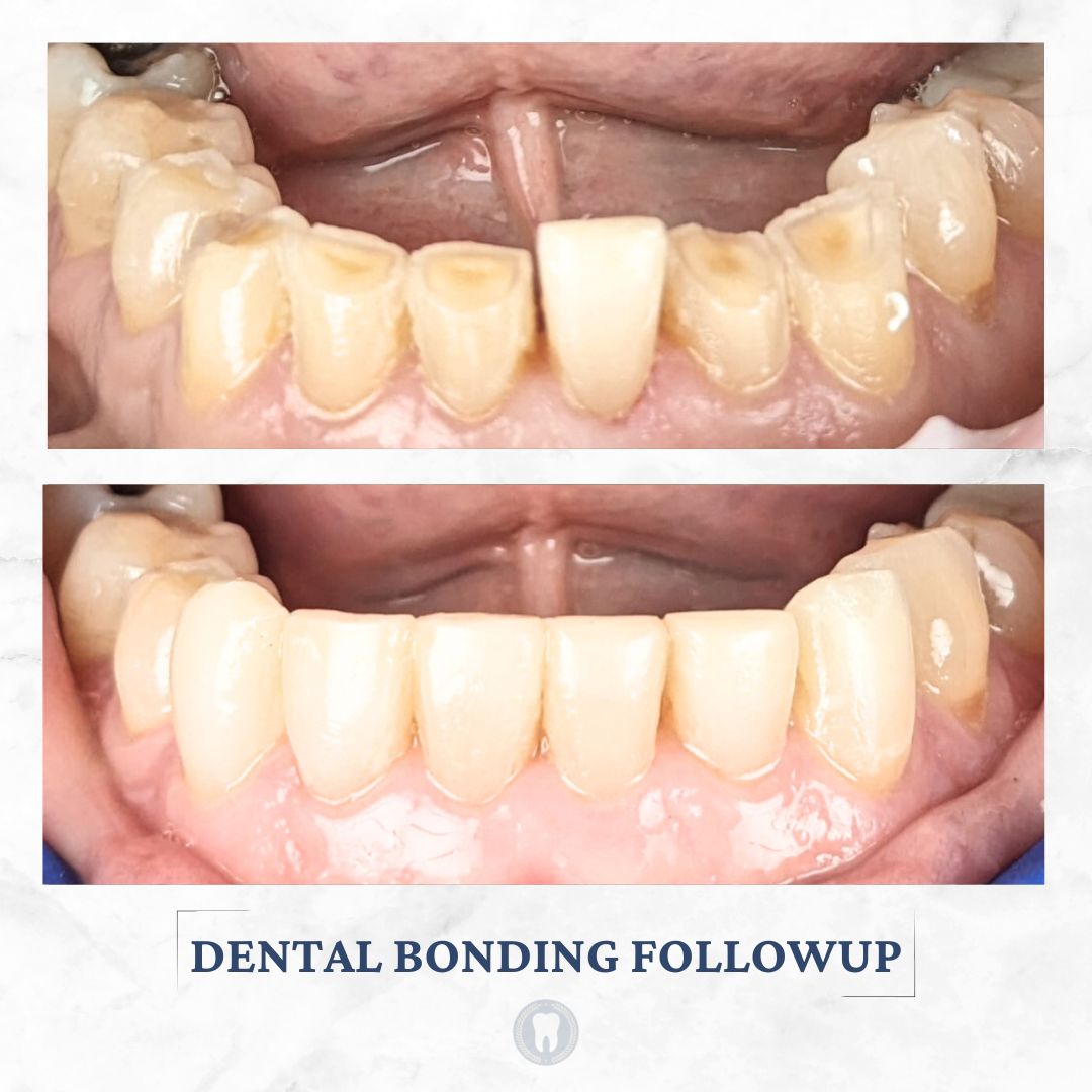 dental bonding easton pa