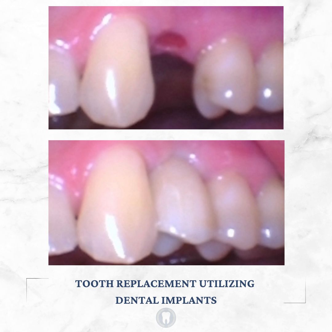 dental implant easton pa