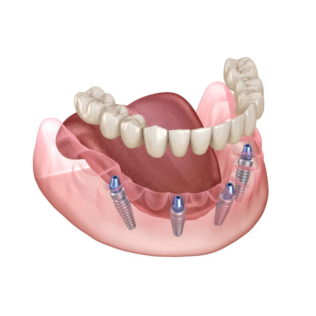 All on 4 dental implants Easton PA