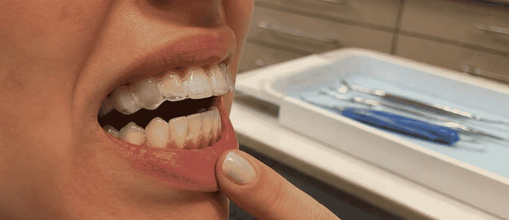 Invisalign Not Moving Fast Enough? When to Adjust Your Plan