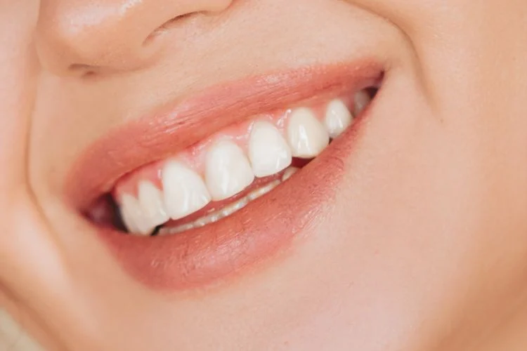 What to Expect from a Dental Veneers Procedure