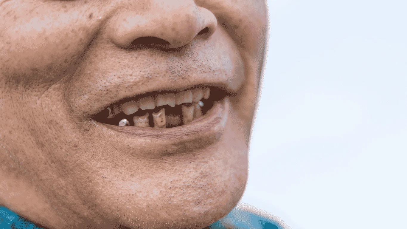 Best Option for Replacing Multiple Missing Teeth: Practical Solutions for Your Smile